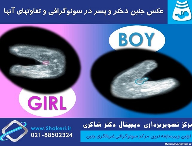 عکس جنین دختر و پسر در سونوگرافی و تفاوتهای آنها