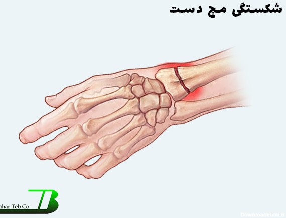 شکستگی مچ دست | بهارطب کاران | روش های درمانی شکستگی مچ دست