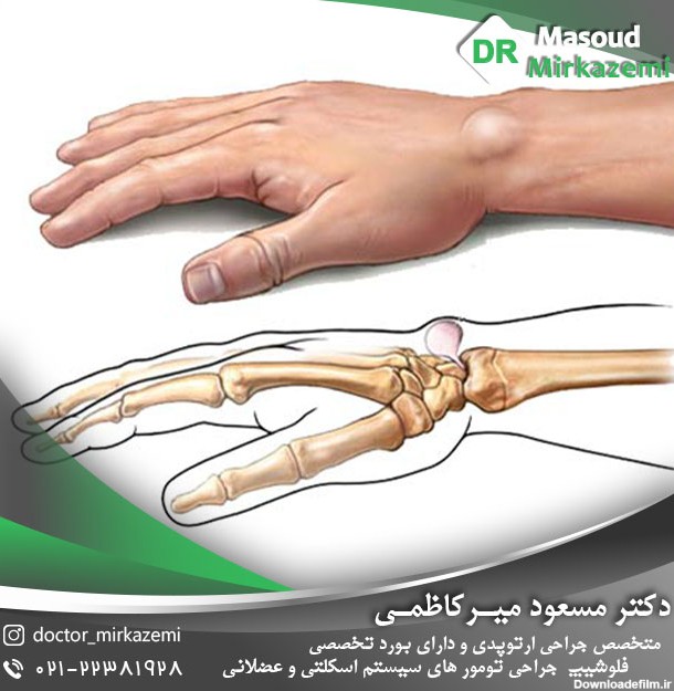 علائم کیست مچ دست | علل کیست مچ دست | درمان کیست مچ دست - دکتر ...