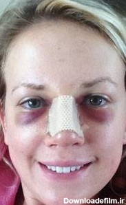 درمان قطعی کبودی دور چشم بعد از جراحی بینی | سیاهی زیر چشم بعد از عمل