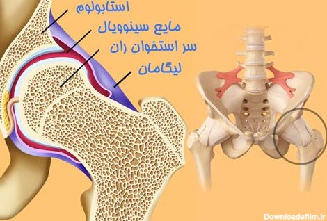 درمان دررفتگی مادرزادی لگن و مفصل ران - دکتر مهرداد منصوری