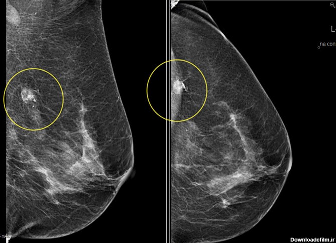 همه چیز در مورد ماموگرافی (Mammography)