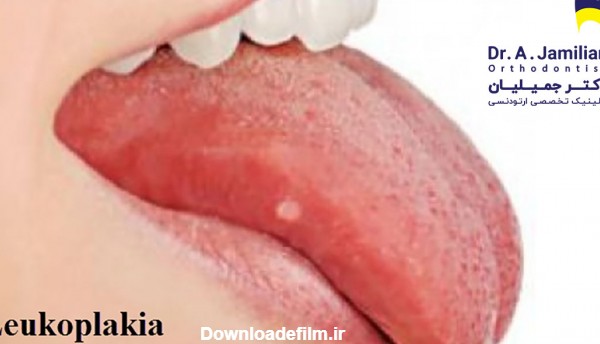 زخمهای سفید داخل دهان یا لکوپلاکیا - دکتر جمیلیان