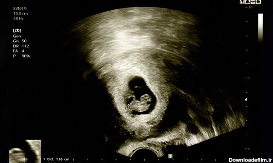 عکس جنین یک ماهه
