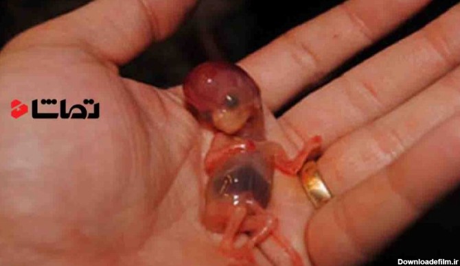 جنین تازه سقط شده انسان - سیگنال - تماشا