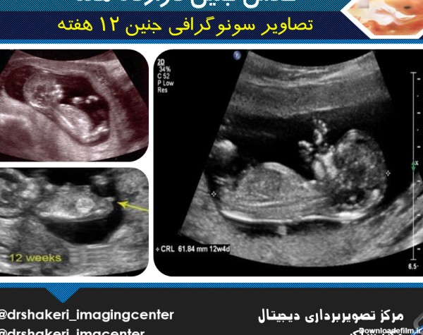 عکس سونوگرافی جنین 12 هفته