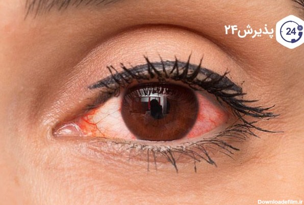 عفونت چشمی