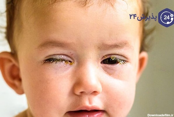 عفونت چشم کودکان