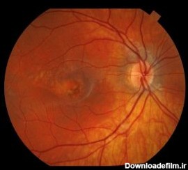 عکس رنگی شبکیه - کلینیک فوق تخصصی جراحی چشم بینا