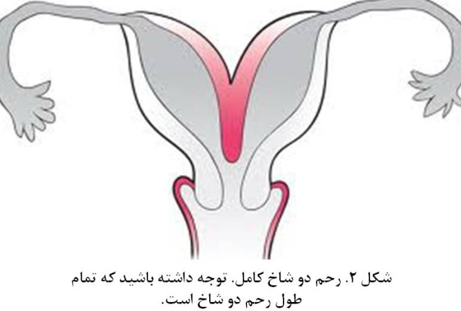 فیلم عکس رنگی رحم دوشاخ