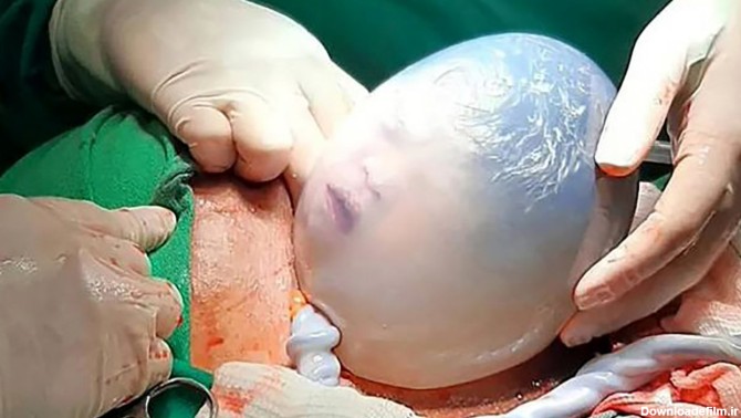 تولد عجیب ترین نوزاد جهان ! / فقط هاله سرش را ببینید شوکه می ...