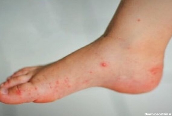 علت وجود لکه‌های قرمز روی پا چیست؟