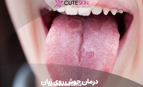 درمان جوش روی زبان؛ علائم، دلایل و روش درمان زخم روی زبان - کیوت ...