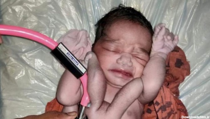 نوزاد عجیب الخلقه ای که «بت» هندی‌ ها شده است (+عکس)