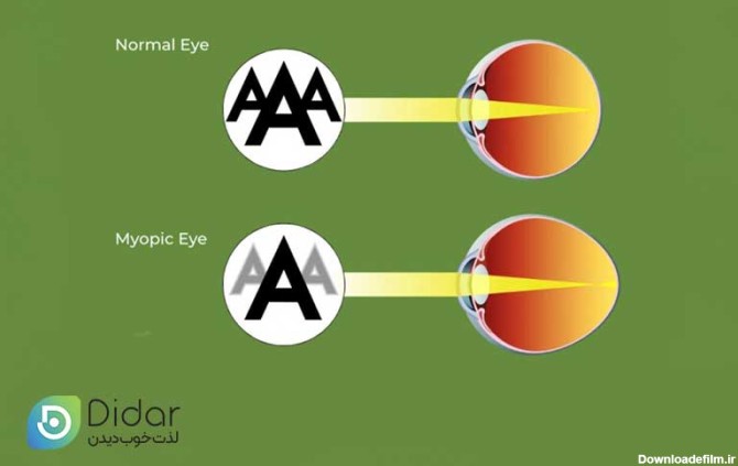 انواع-نزدیک-بینی-چشم-کلینیک-چشم-دیدار
