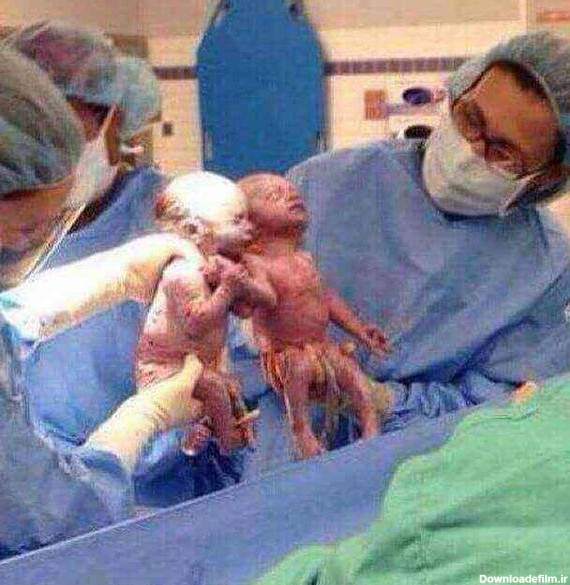 دوقلوهایی که تا لحظه به دنیا آمدن، دستان یکدیگر را رهانکردند/عکس
