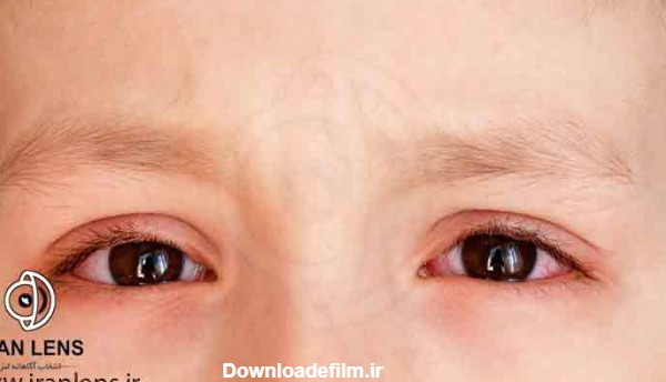 ضعیفی چشم در کودکان و بررسی علائم اختلالات بینایی در آن ها ...