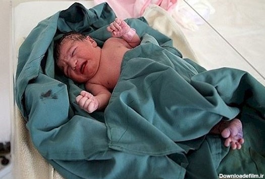 نوزادی که باردار بود! +عکس