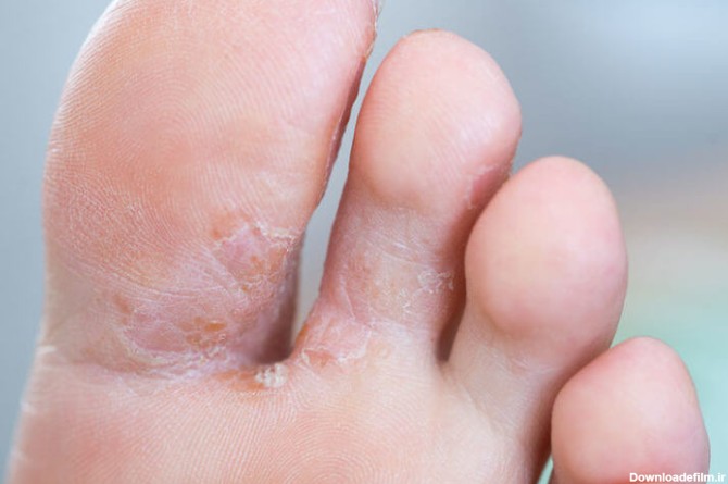 علت سوزش کف پا | علت سوزش کف پا در شب چیست | دکتر غلامرضا نادری