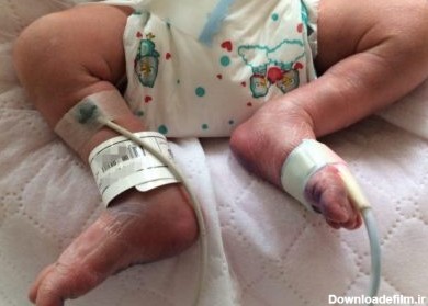نوزادی که باردار به دنیا آمد (+عکس) - عصر خبر
