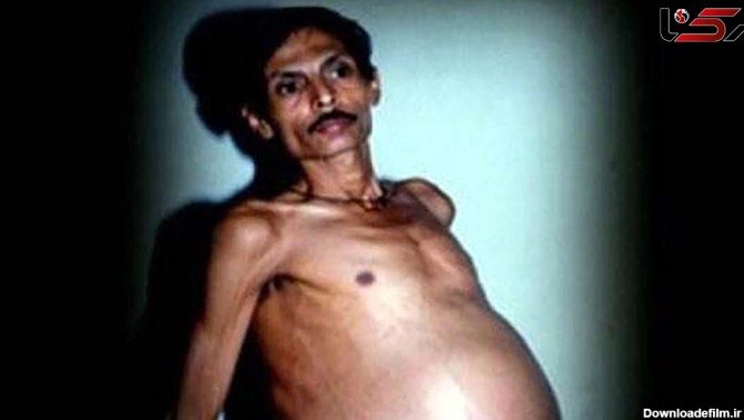 تولد نوزاد ناقص الخلقه از شکم مرد هندی باردار بعد از 36 سال ...