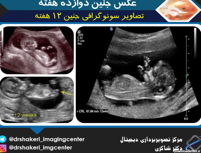 عکس سونوگرافی جنین 12 هفته
