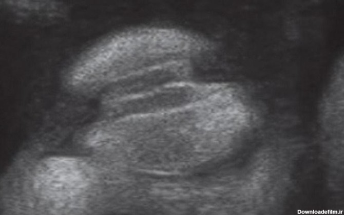 سونوگرافی جنین در هفته 36 بارداری