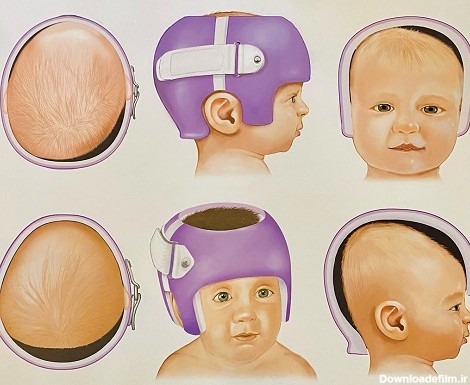 کلاه فرم دهی سر نوزاد برای درمان انواع بدشکلی جمجمه | کلینیک ارتوز ...