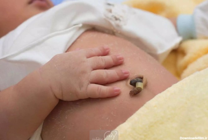 گرانولوم ناف در نوزادان چیست؟ || پزشکت