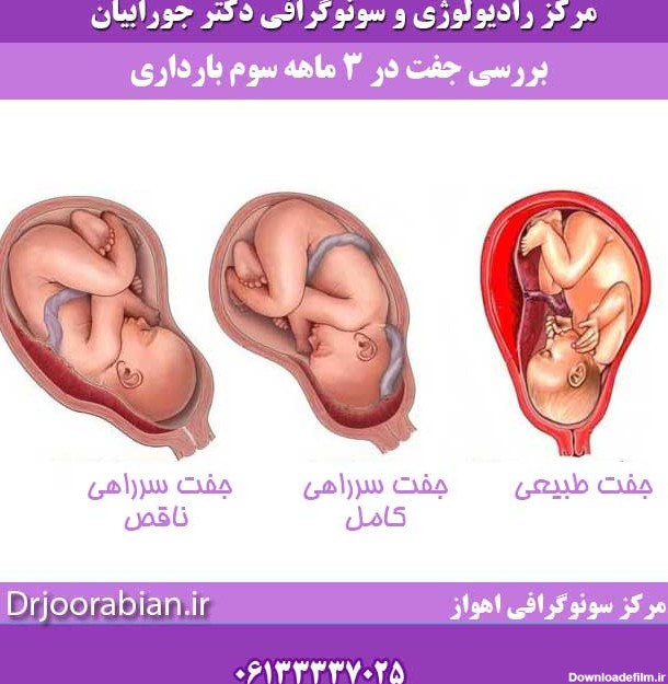 بررسی جفت در ٣ ماهه سوم بارداری | تعیین محل جایگزینی جفت در سه ...