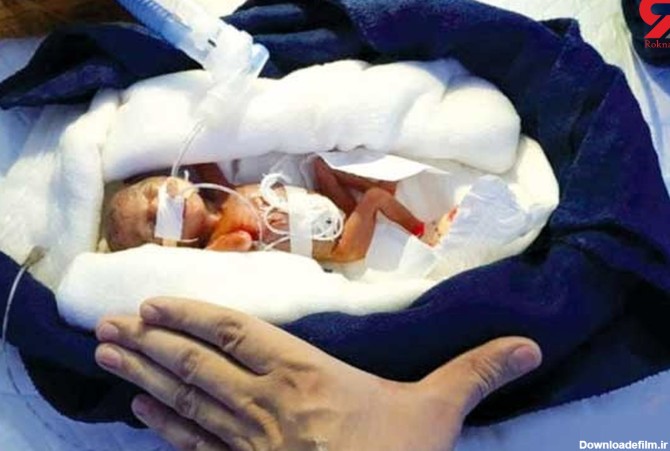 کم وزن‌ترین نوزاد جهان به دنیا آمد + عکس