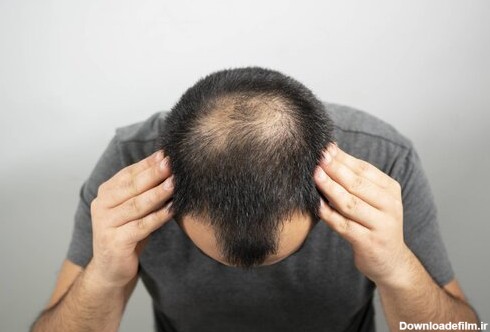 ترمیم و رشد موهای ریخته شده در سریع ترین زمان - خبرآنلاین