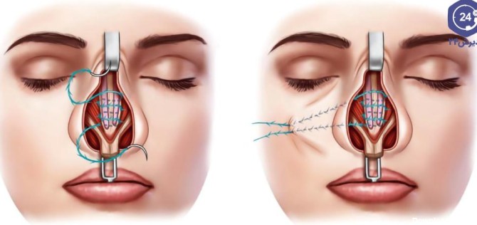 بخیه داخل بینی پس از عمل