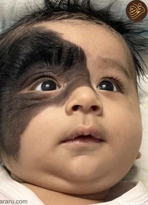 فرارو | (تصاویر) تولد نوزادی با خال غول‌پیکر مودار روی صورتش