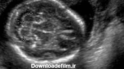 شرح تصاویر سونوگرافی جنین در بارداری - سونوگرافی و رادیولوژی صدرا