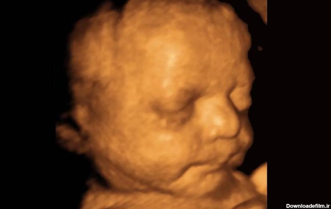 در این تصویر می‌توانید سونوگرافی سه بعدی جنین را در هفته ۳۳ بارداری مشاهده کنید.