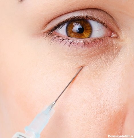 تزریق ژل زیر چشم روشی برای رفع گودی و سیاهی زیر چشم + هزینه