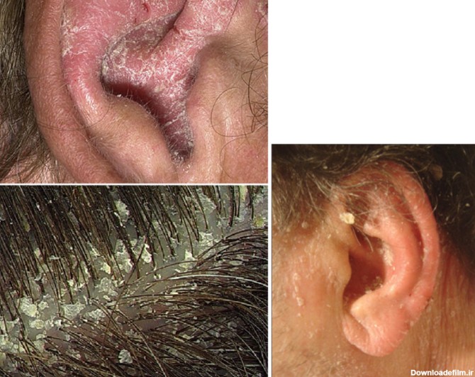 انواع عفونت های پوستی گوش - روش های درمان عفونت های پوستی گوش ...