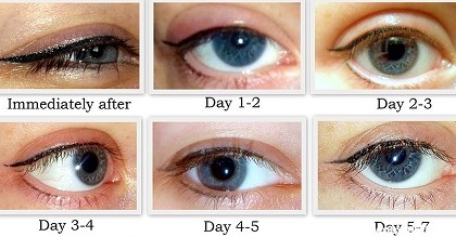 راههای کاهش و عوارض التهاب چشم بعد از تاتو خط چشم