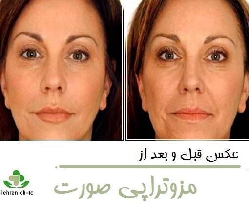 عکس قبل و بعد از مزوتراپی صورت 💙 - تهران کلینیک
