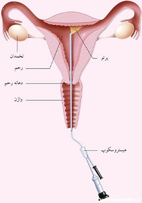 طریقه انجام عکس رنگی از رحم