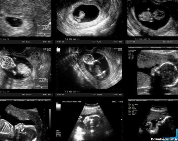 سونوگرافی بارداری - آنچه که باید در دوران بارداری و حاملگی بدانید