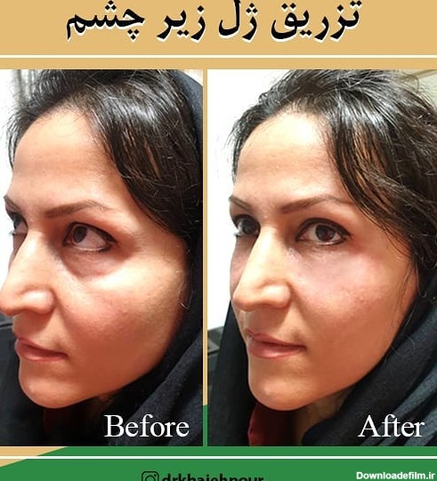 تزریق ژل زیر چشم (نمونه 1) - جوانسازی پوست اصفهان