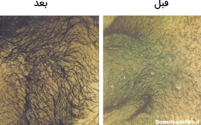تصویر 2: شکل و عکس زگیل تناسلی مردان بالای آلت قبل و بعد از درمان با لیزر