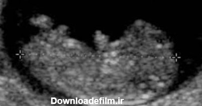 شرح تصاویر سونوگرافی جنین در بارداری - سونوگرافی و رادیولوژی صدرا