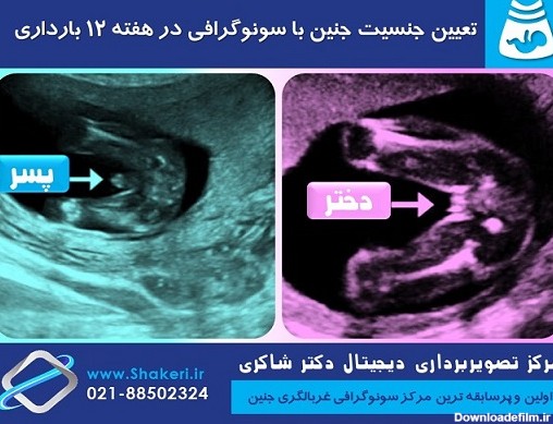 تعیین جنسیت جنین با سونوگرافی در هفته 12 بارداری