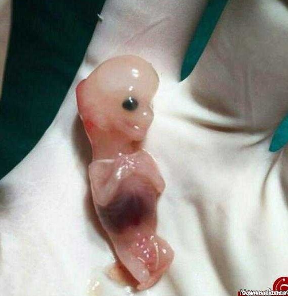سقط جنین | تصویر دردناک سقط جنین 7 هفته ای