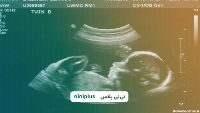 عکس جنین پسر در سونوگرافی و سونوگرافی تعیین جنسیت چگونه است