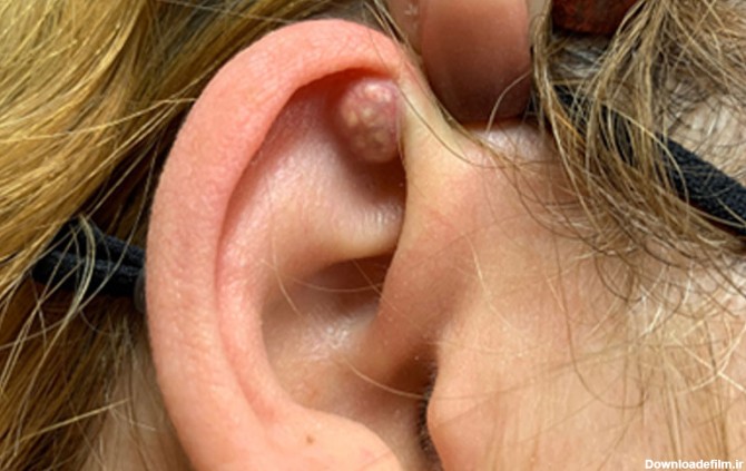 آبسه لاله گوش چیست؟ روش درمان و پیشگیری در خانه