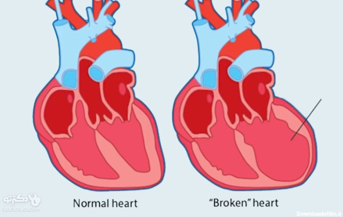 تشخیص سندرم قلب شکسته چگونه انجام می شود؟